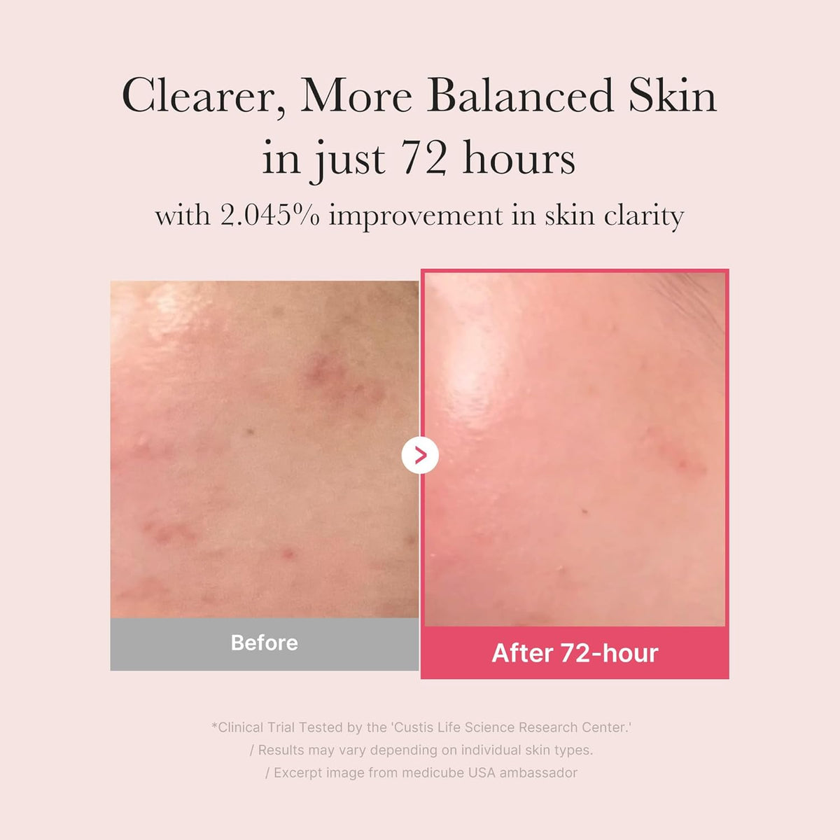 Medicube TXA Niacinamide 15% Serum before and after use result within 72 hours.